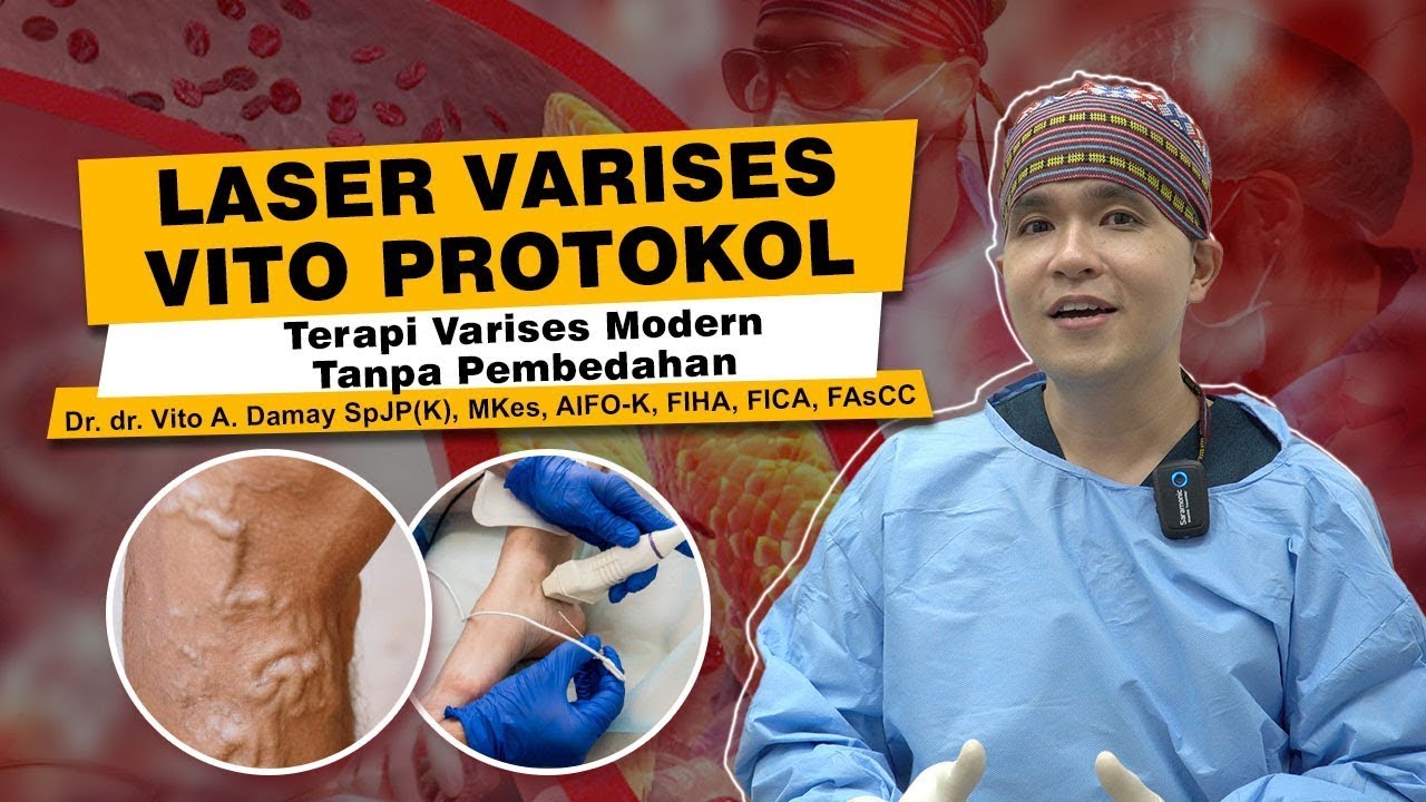 Dr Vito | EVLA / EVLT : Laser Varises Tanpa Pembedahan