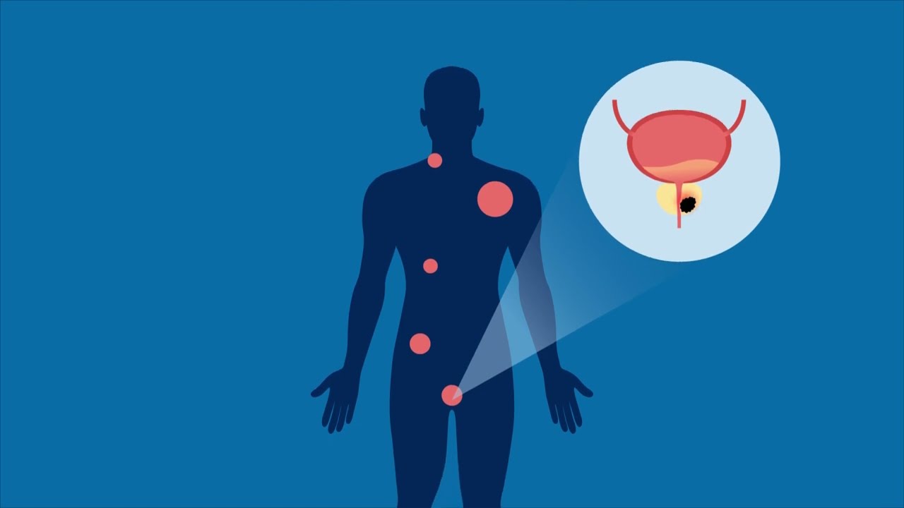 Niraparib and Abiraterone Acetate for Metastatic Castration-Resistant Prostate Cancer