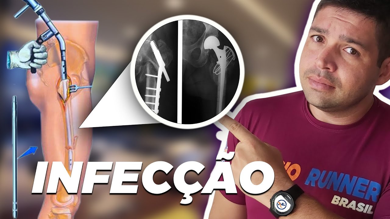 Infecção na Fratura como resolver e qual é o tempo para o osso colar?
