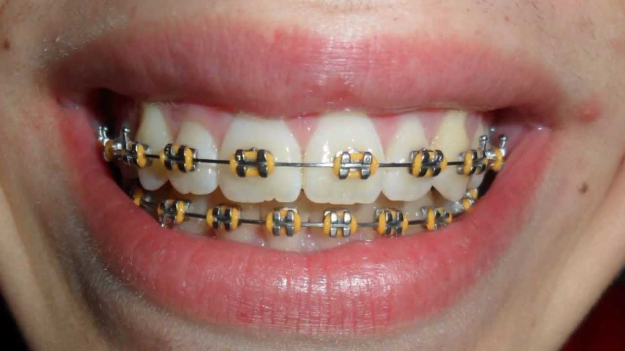 Aparelho ortodontico Antes e Depois- 1 Ano-Braces Before and after- 1-Year