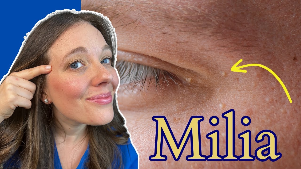How to Get Rid of Milia | Tiny White Bumps