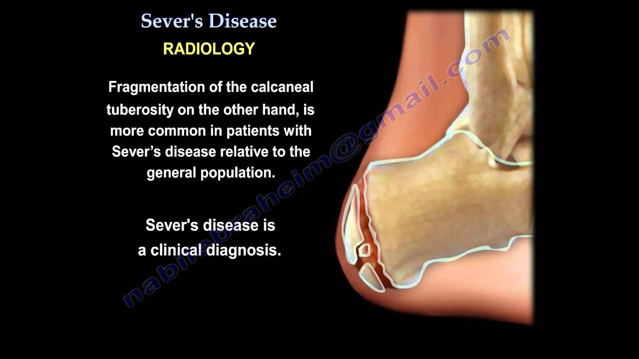 Sever's Disease - Everything You Need To Know - Dr. Nabil Ebraheim