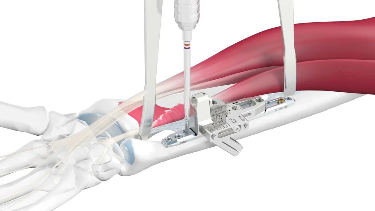 APTUS Wrist Ulna Shortening System 2.5 Surgical Technique