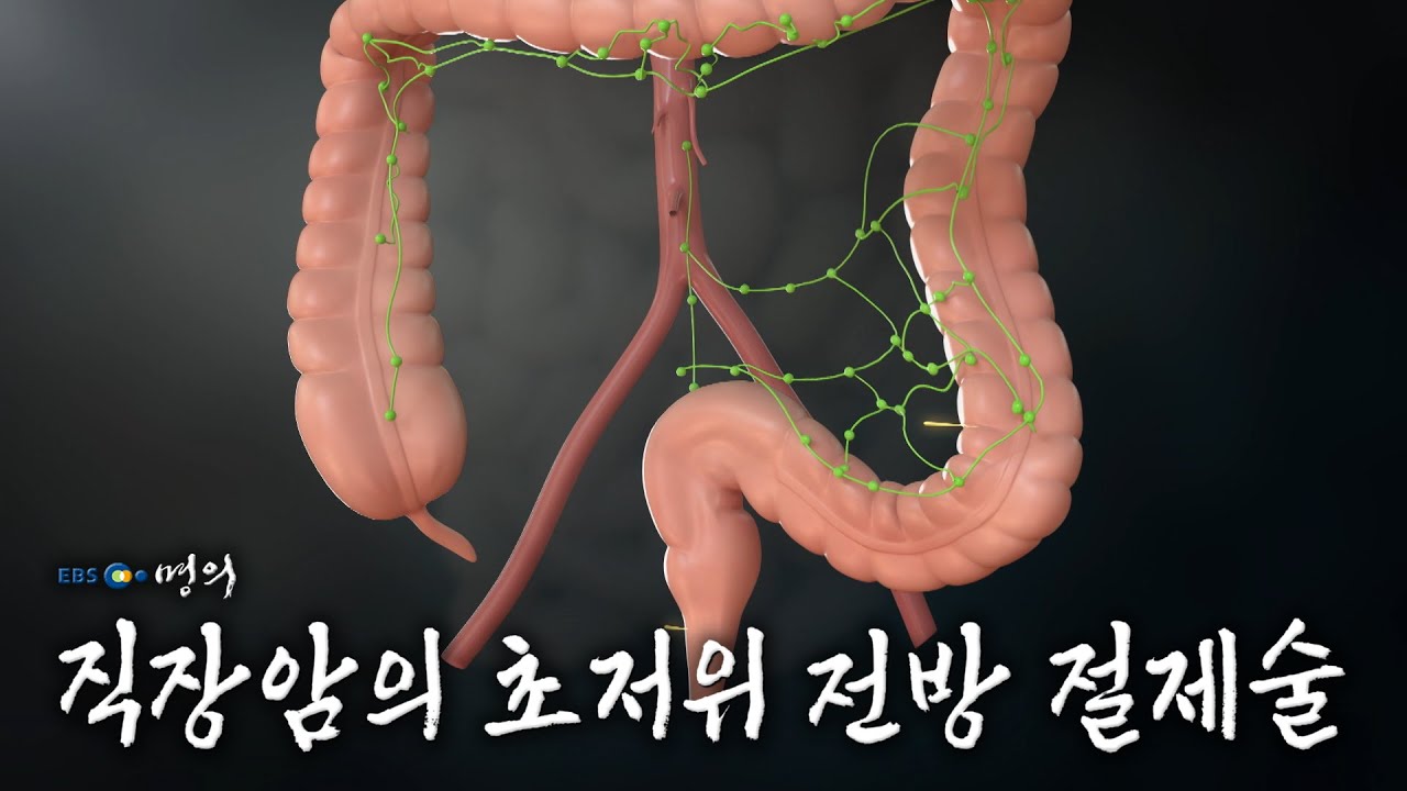 [명의 의학백과📖] 직장암의 초저위 전방 절제술