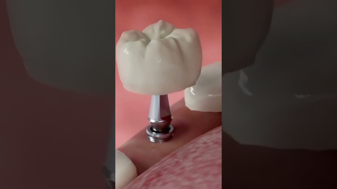 Dental Implant Healing #implantdentist #dentist