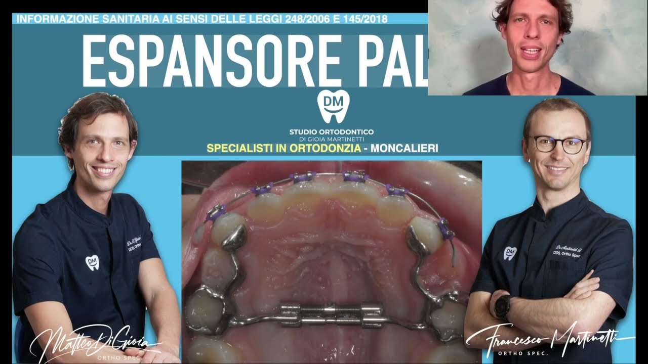 Espansore palatale e palato stretto, incisivi storti e accavallati nei bambini, apparecchio fisso