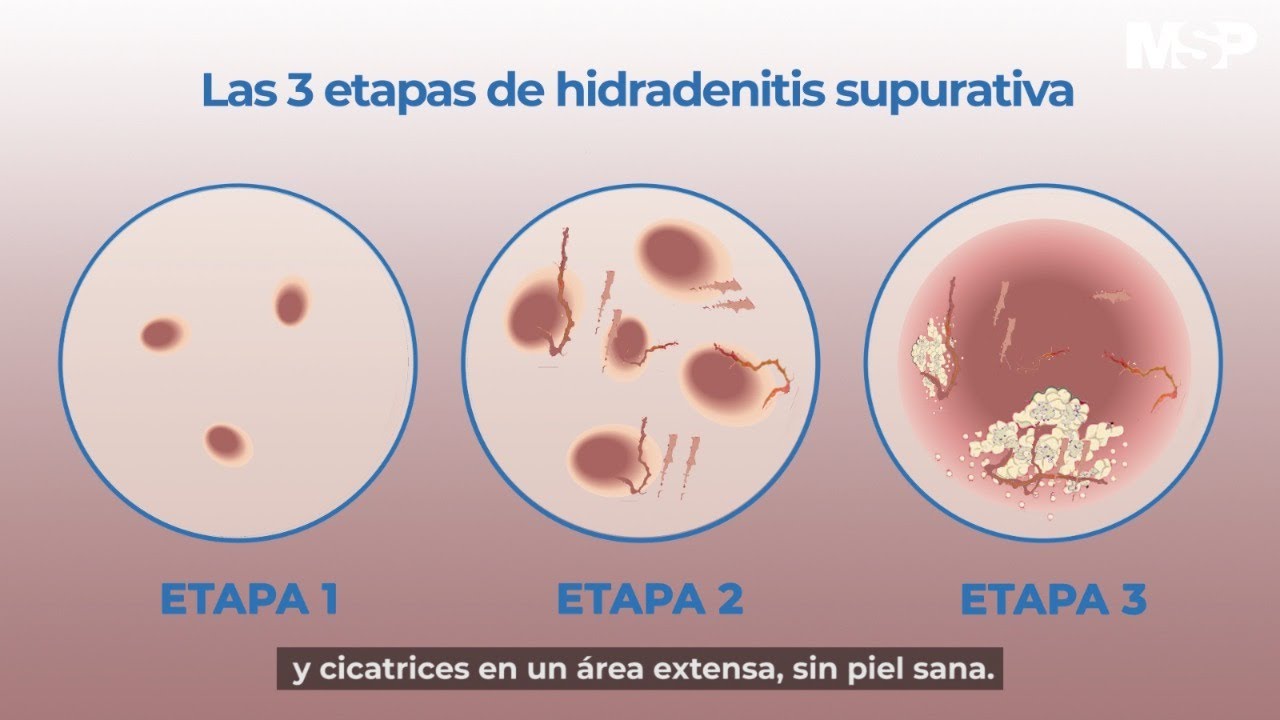 Hidradenitis Supurativa
