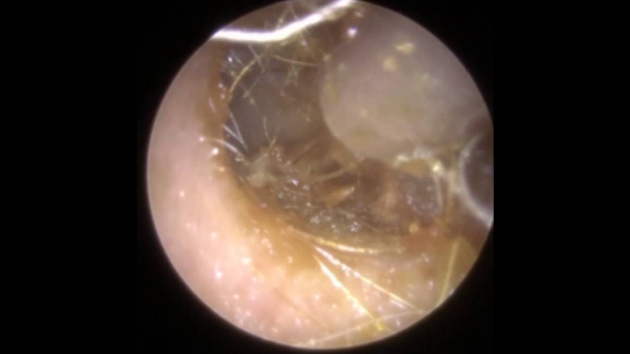 Hairy Ear Wax Removal  - Mr Neel Raithatha (The Hear Clinic - Leicester)
