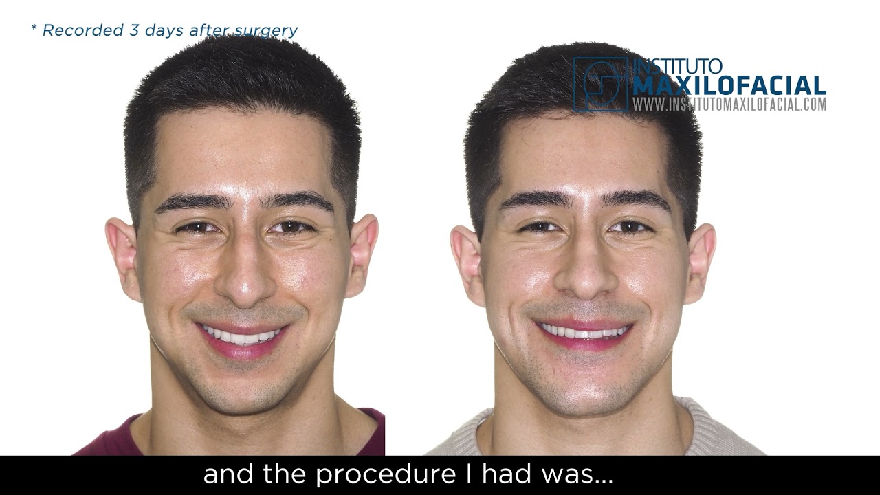 Jaw surgery Case # 92: Rodrigo - Class II, maxilo-mandibular biretrusion