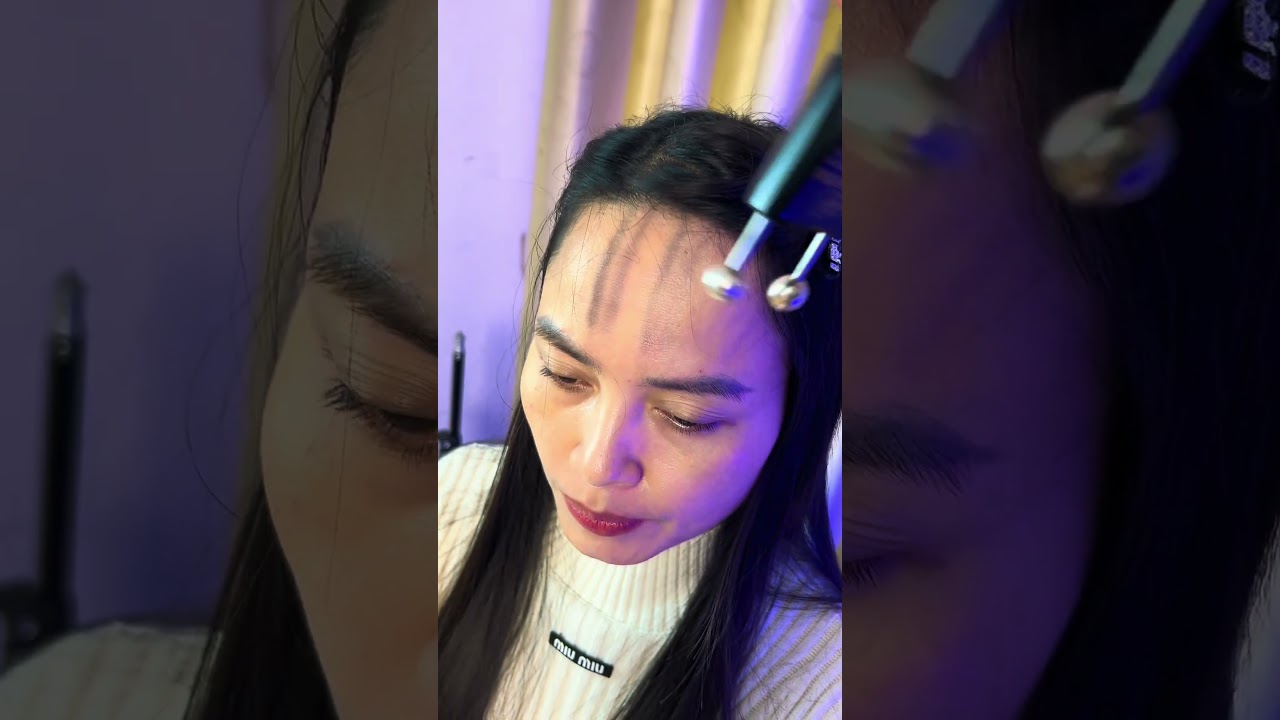Cạo gió đúng cách   Vùng trán   Bọ cạp sừng bạc Bách Chi