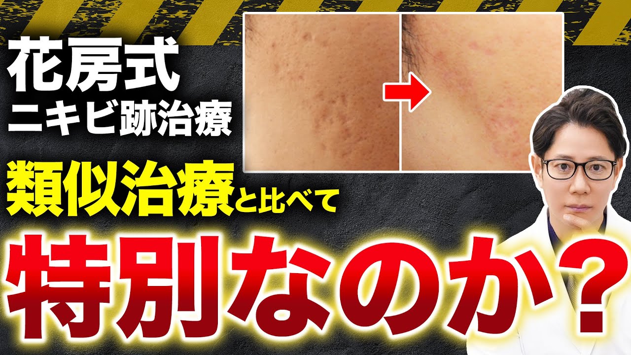 【ニキビ跡】花房式ニキビ跡治療と他院の類似治療との決定的な違いを解説