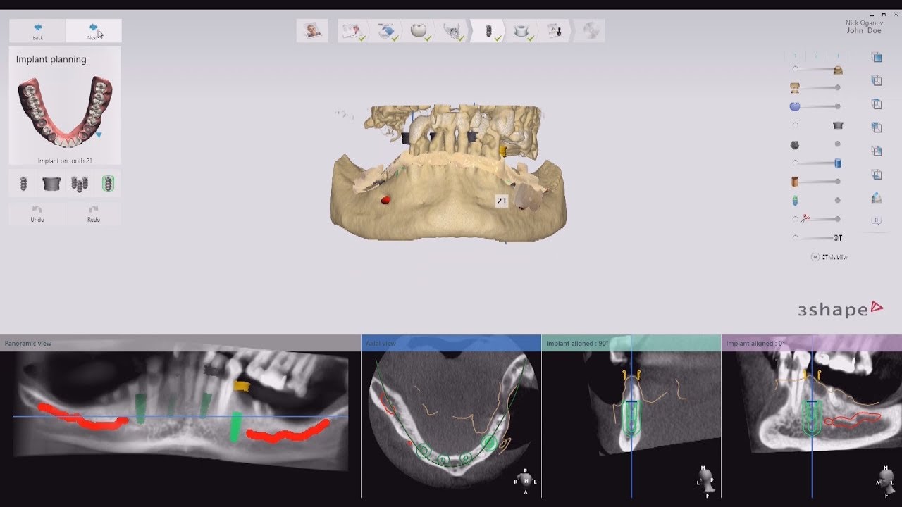 Fabrication of a Surgical Guide using a 3D printer and 3D X-ray