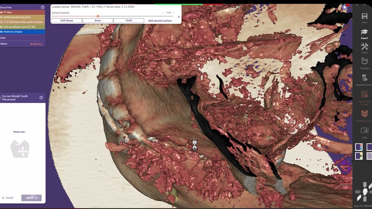 Exoplan Surgical Guide Design Tutorial: Step-by-Step Guide for Beginners