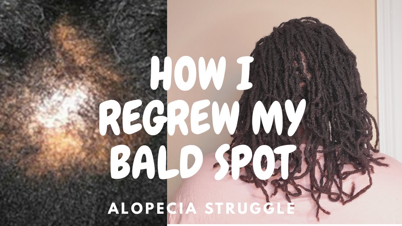 How I regrew my Bald Spot / Alopecia and locs 2023