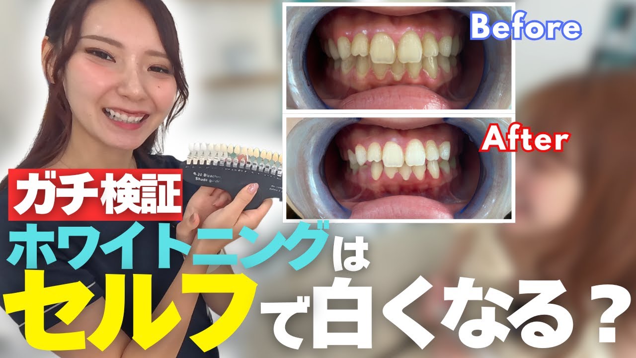 【ガチ検証】街の女性にセルフホワイトニングを体験してもらいました。