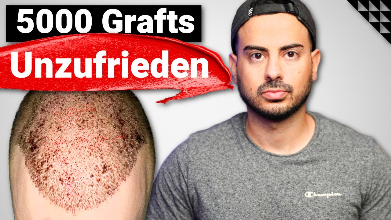 6 Monate nach 5000 Grafts | Haartransplantation Ergebnis eines Norwood 5