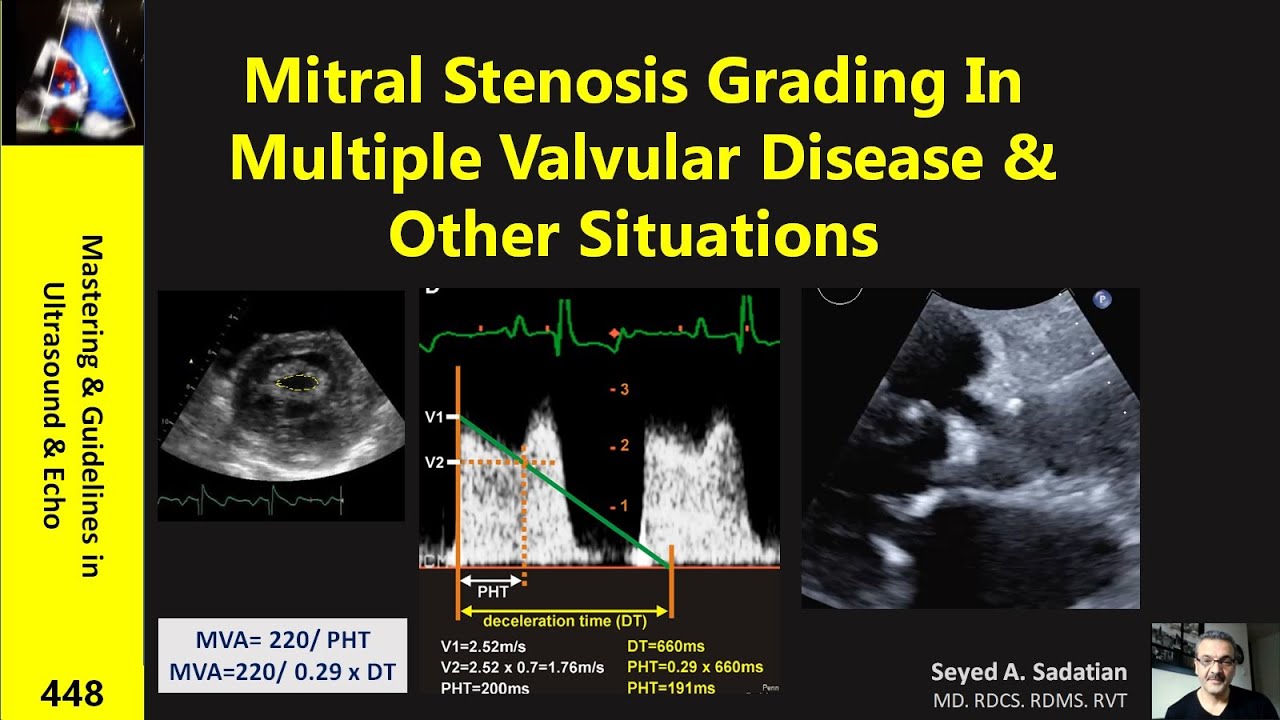 Mitral Stenosis Grading In Multiple Valvular Disease & Other Situations