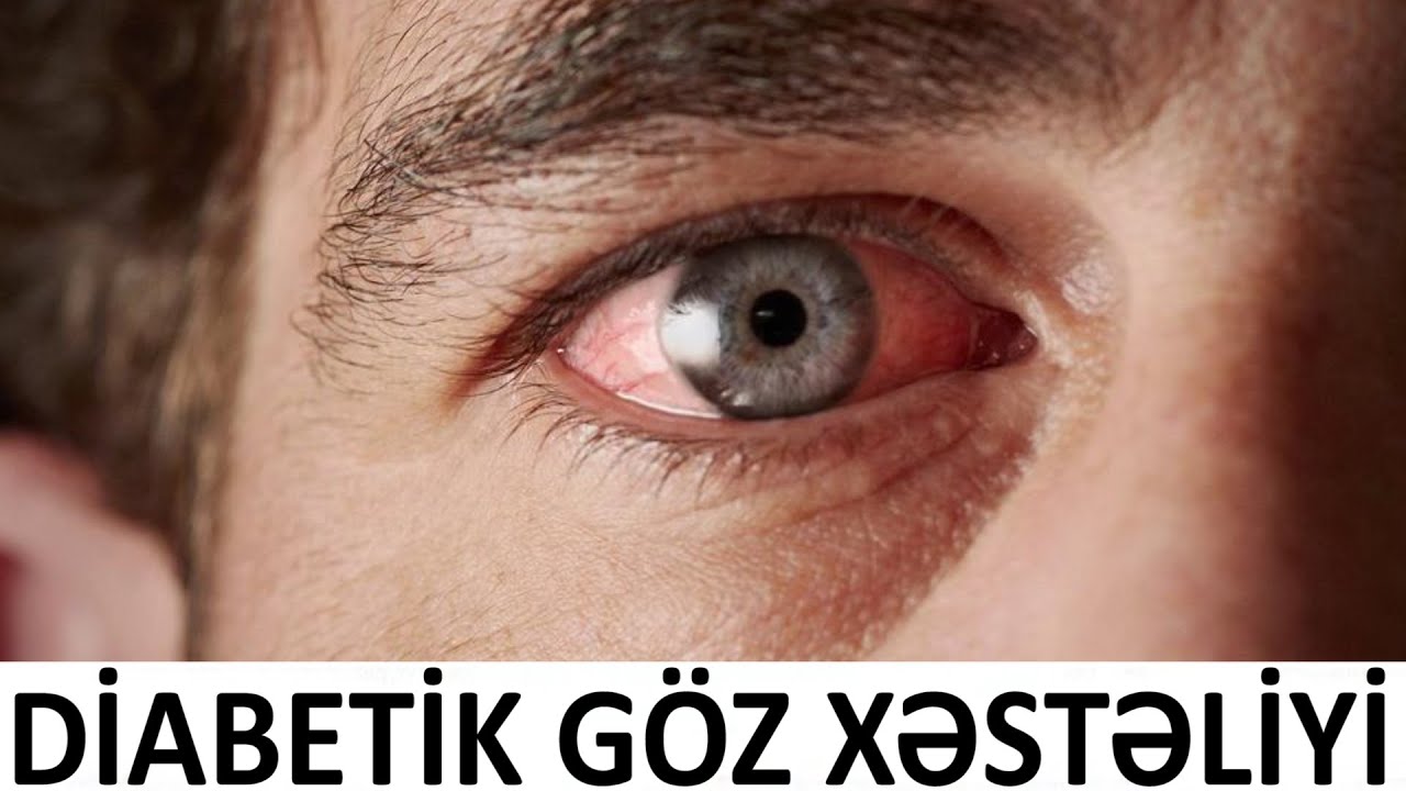 Şəkər xəstəliyi gözləri zəiflədir! - Diqqət!