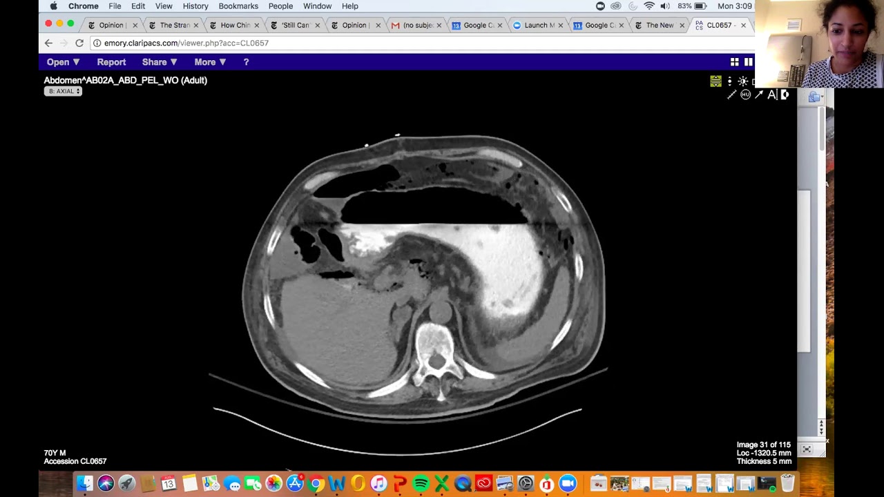 Complication after right hepatectomy. Learn what a Kocher maneuver is (Aarti Sekhar)