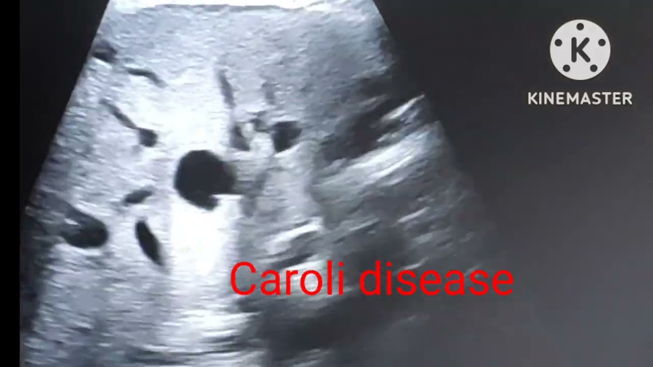 Caroli disease ---- Neet PG