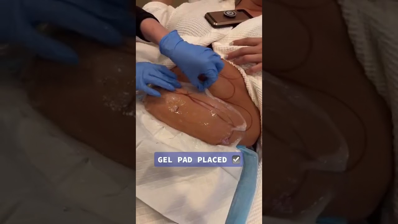 Full Abdomen CoolSculpting
