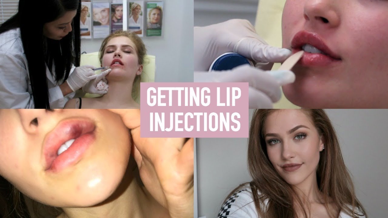 I GOT LIP INJECTIONS + THE PROCESS! | Mel Joy