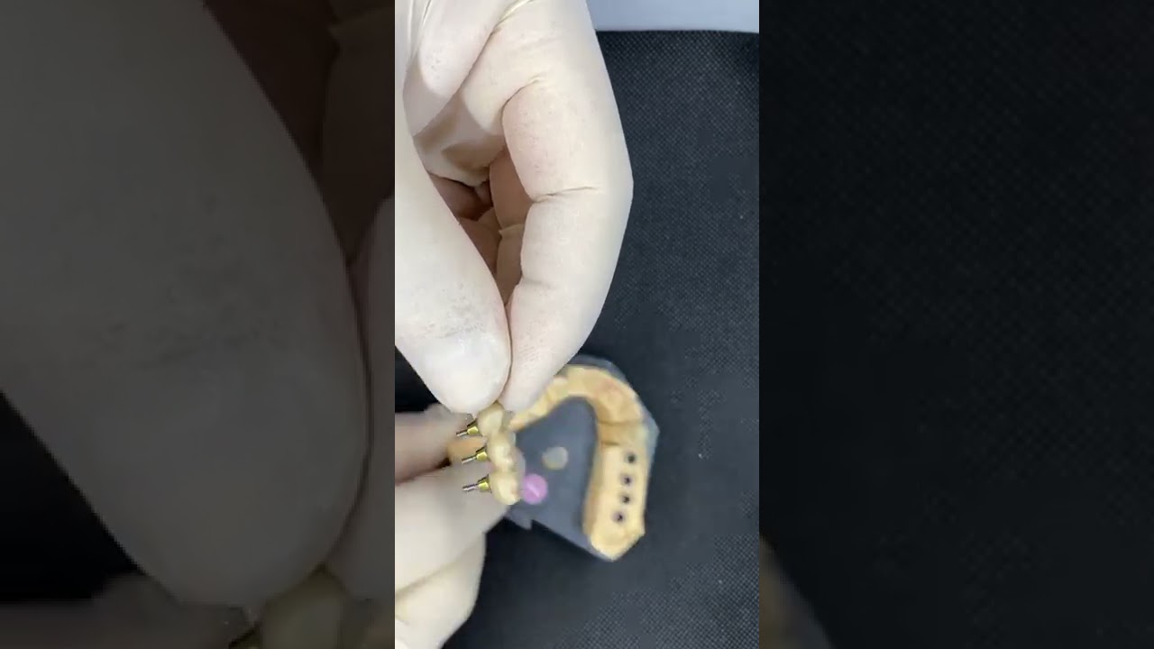 Csavarozással rögzülő híd Nobel Biocare implantátumokra