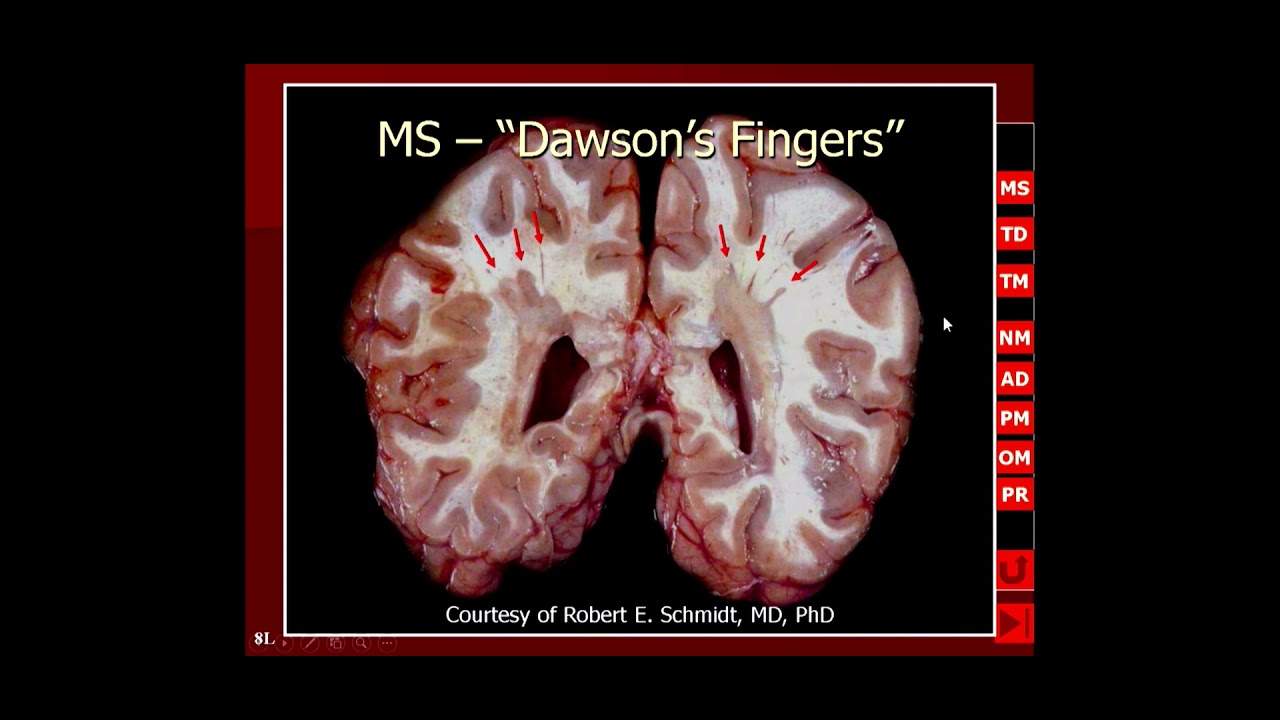 Neuro imaging: white matter diseases