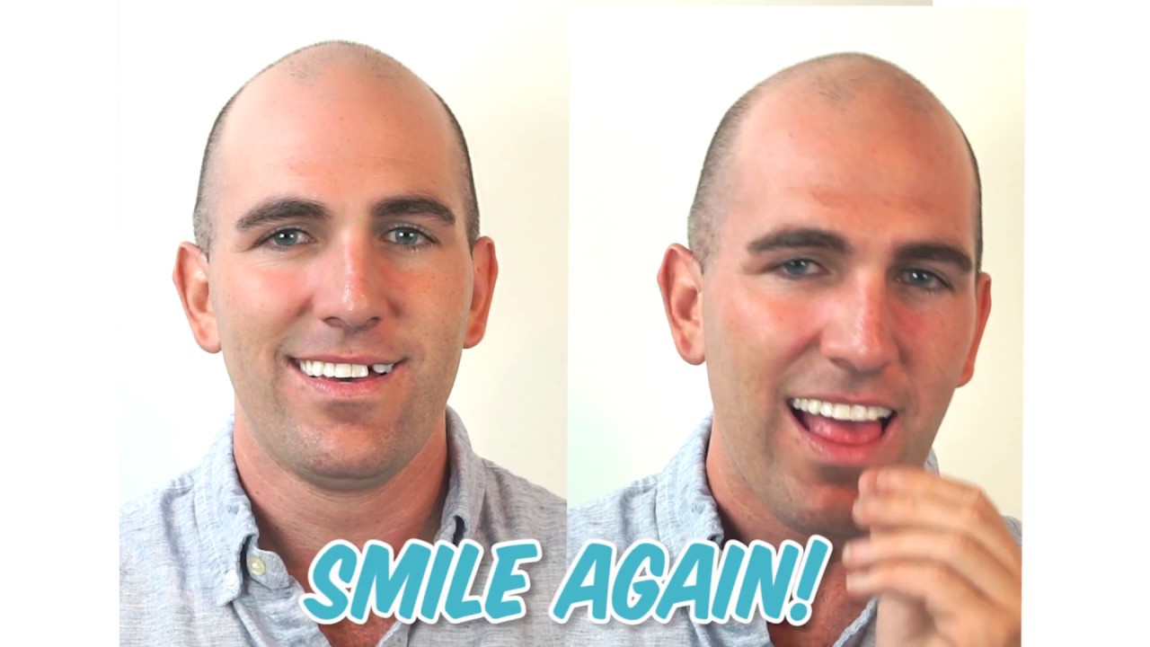 Instant Smile Triple Shade Temporary Tooth Replacement Kit