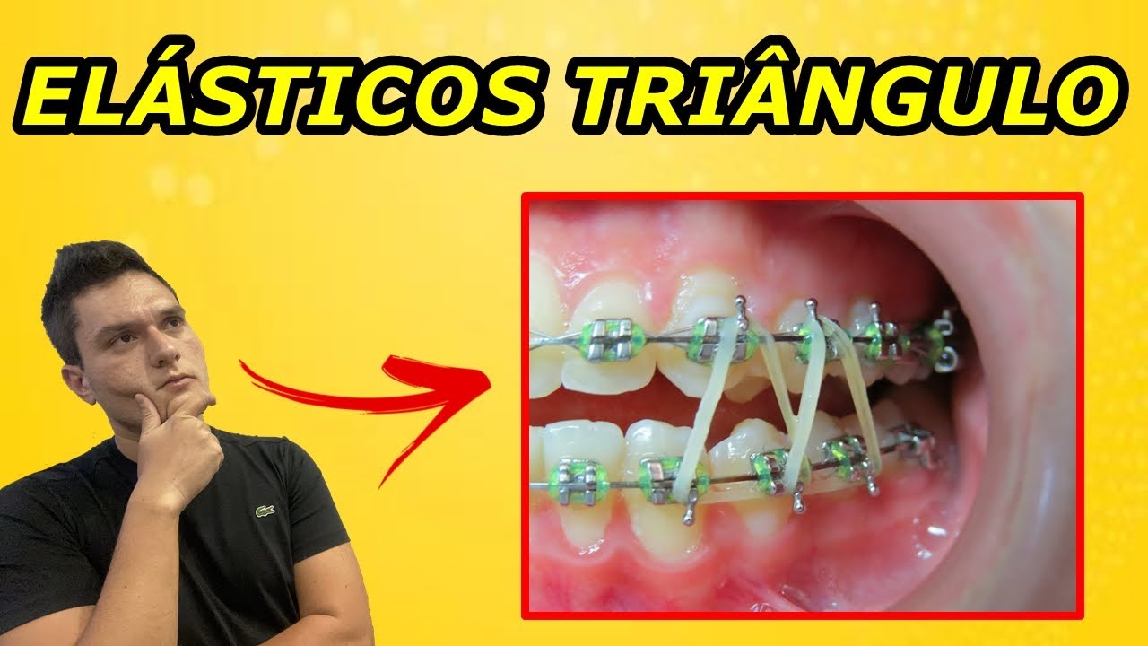 ELÁSTICOS EM TRIÂNGULO NO APARELHO ORTODÔNTICO | PARA QUE SERVEM?