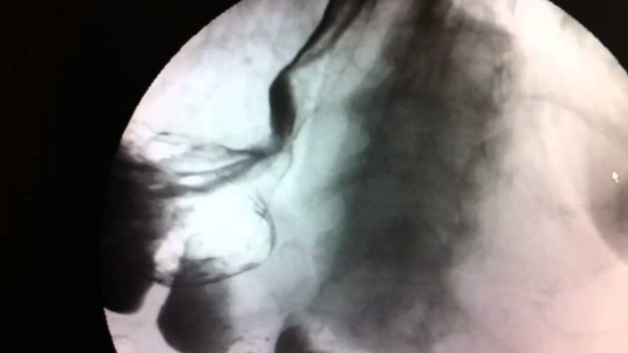 Schatzki ring of oesophagus