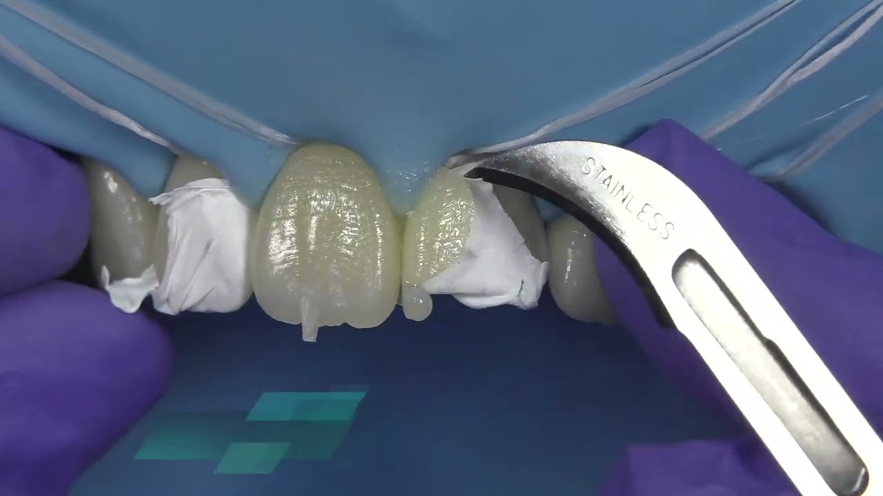 GC's Direct Restorative Solutions - Injection Molding Technique