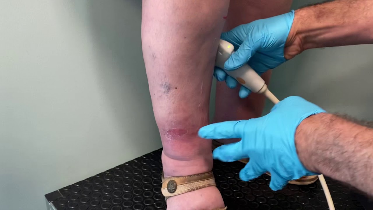 SKIN CHANGES SECONDARY TO VENOUS HYPERTENSION