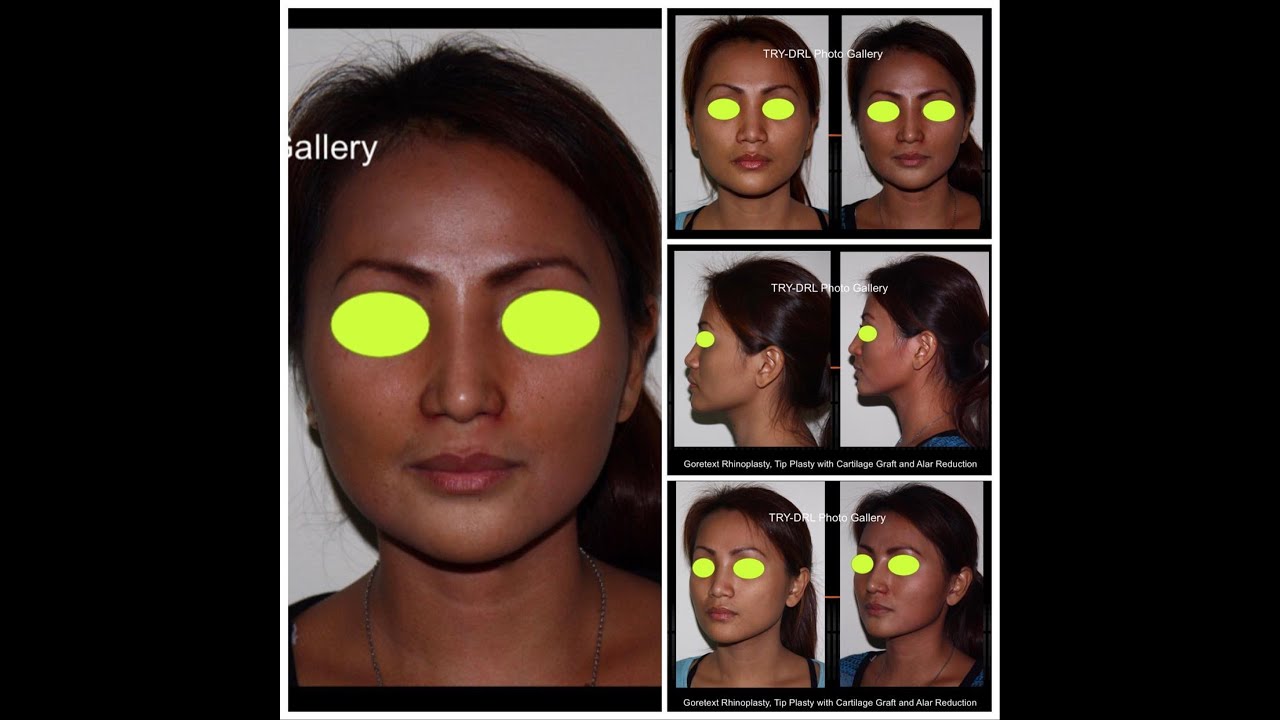 Nasal enhancement : Philippines Rhinoplasty