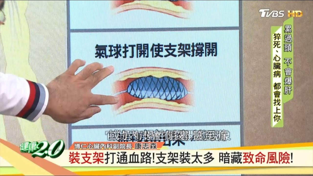 裝支架打通血路！支架裝太多 小心暗藏致命風險！ 健康2.0