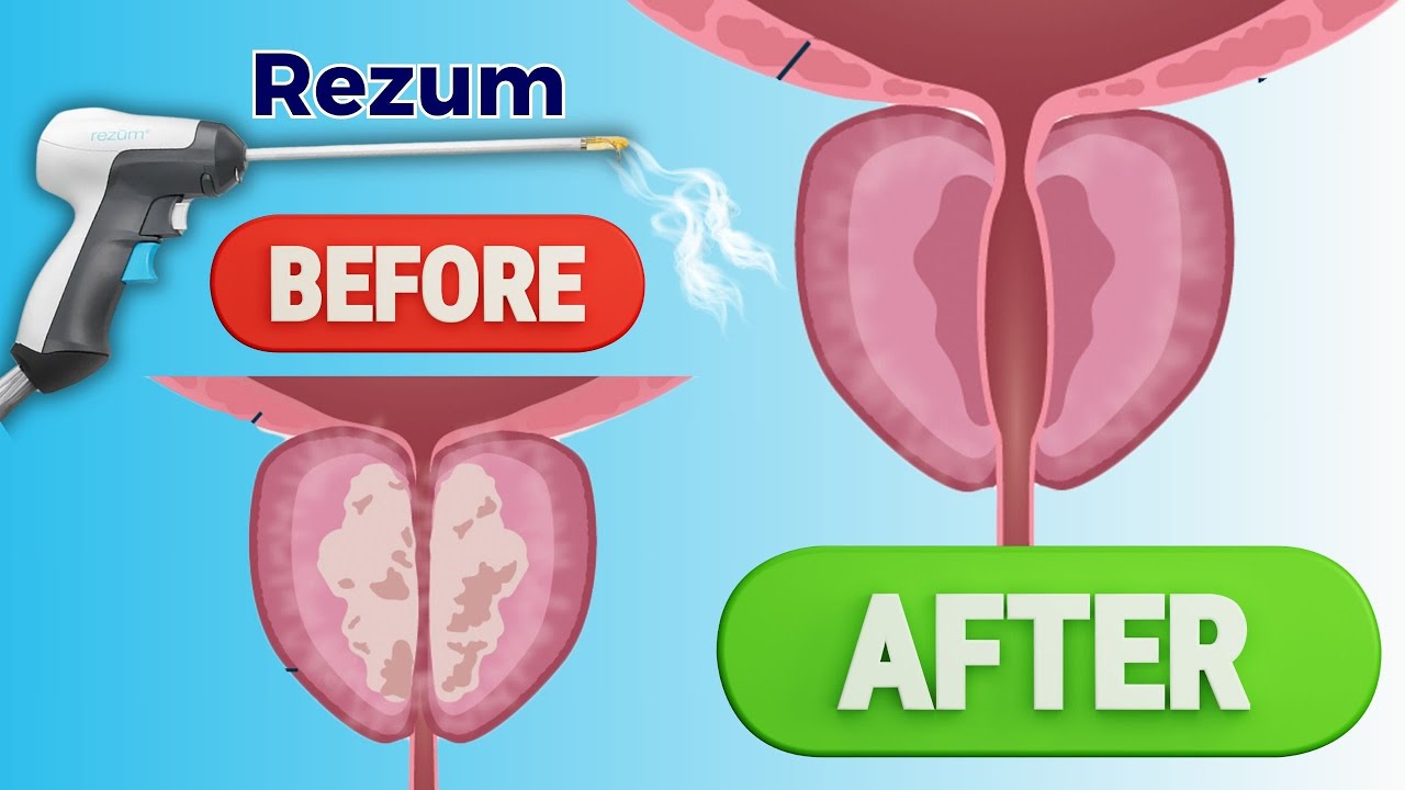 See Rezum&trade; Water Vapor Therapy EXPLAINED in 3D! | No Surgery, Fast Relief!