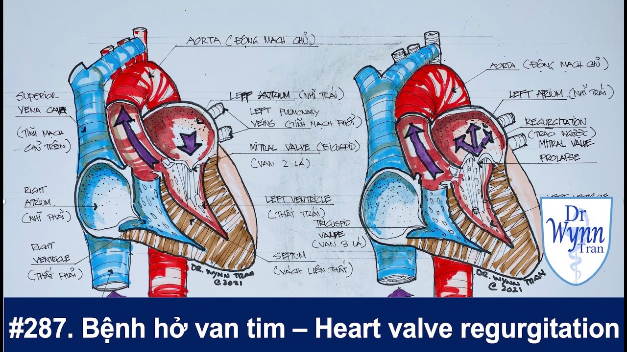 # 287. Bệnh hở van tim triệu chứng và cách chữa trị