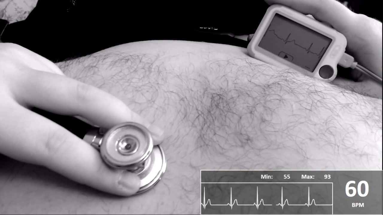 PVC,ECG, different sounds