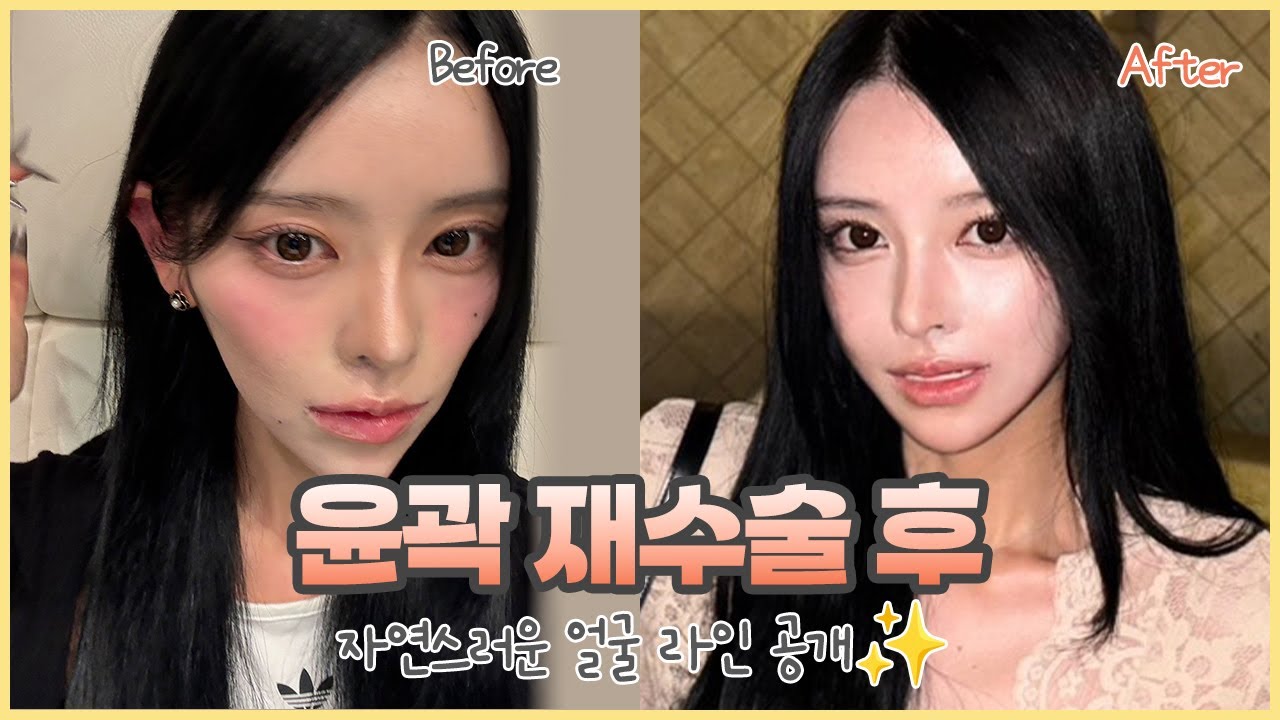 [글램성형외과] 윤곽재수술 후 놀라운 변화! 일본 인플루언서 얼굴 공개💕