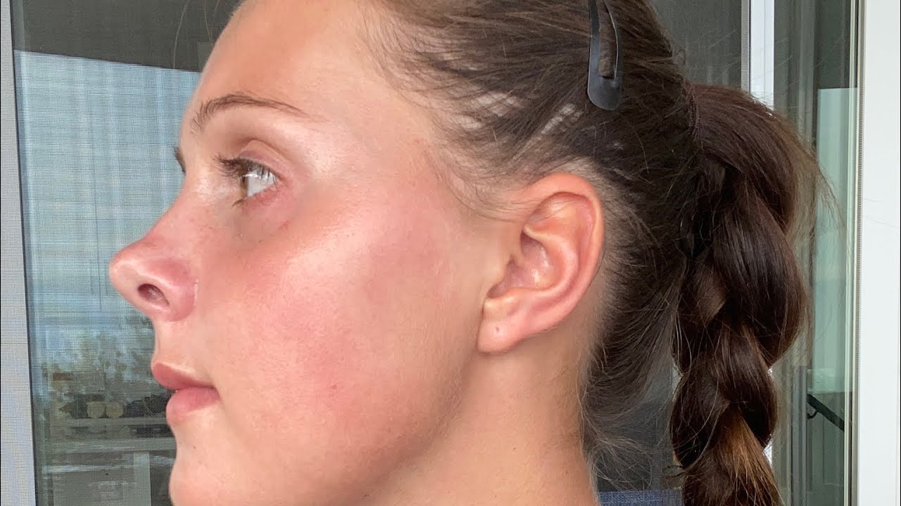 DOUBLE JAW SURGERY!! Week 4 post op updates!!