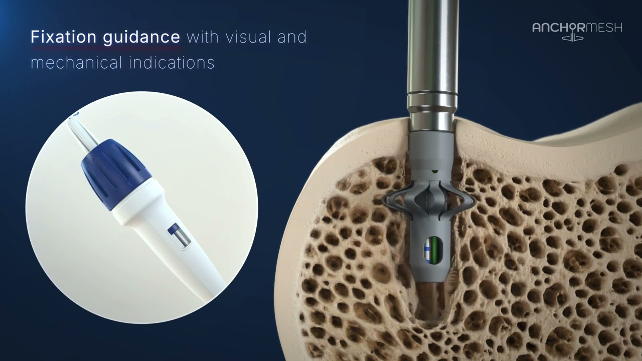 AnchorMesh - Smart Implant Fixation - Animations