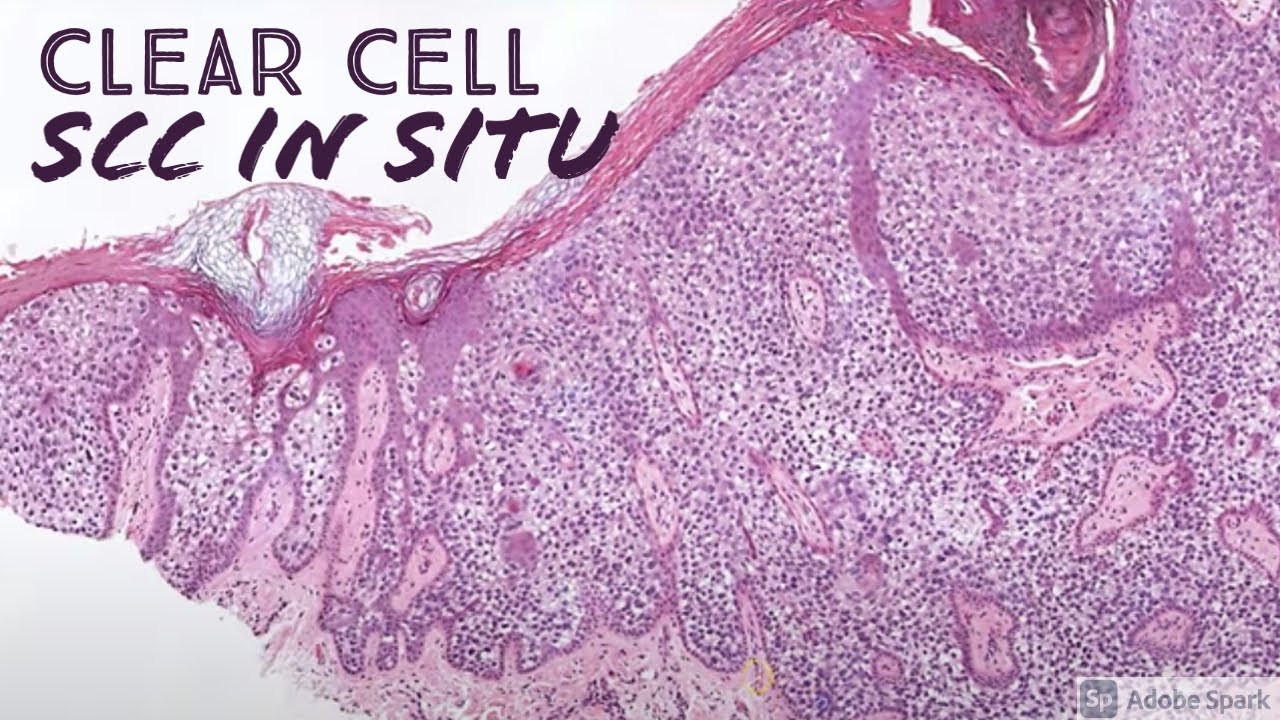 Clear cell squamous cell carcinoma in situ (Bowen disease) with pagetoid (dermpath dermatology)