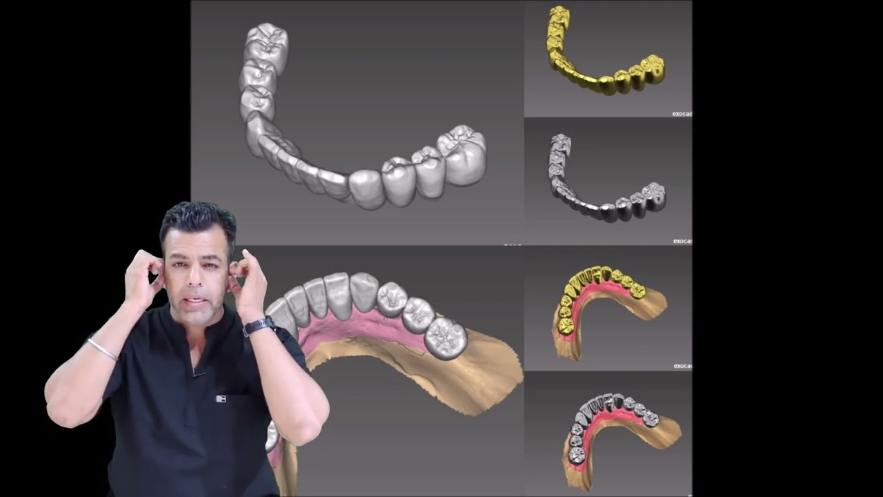 Learn about Anterior Deprogrammer | Muscle Deprogramming | Full Mouth Dental Implants