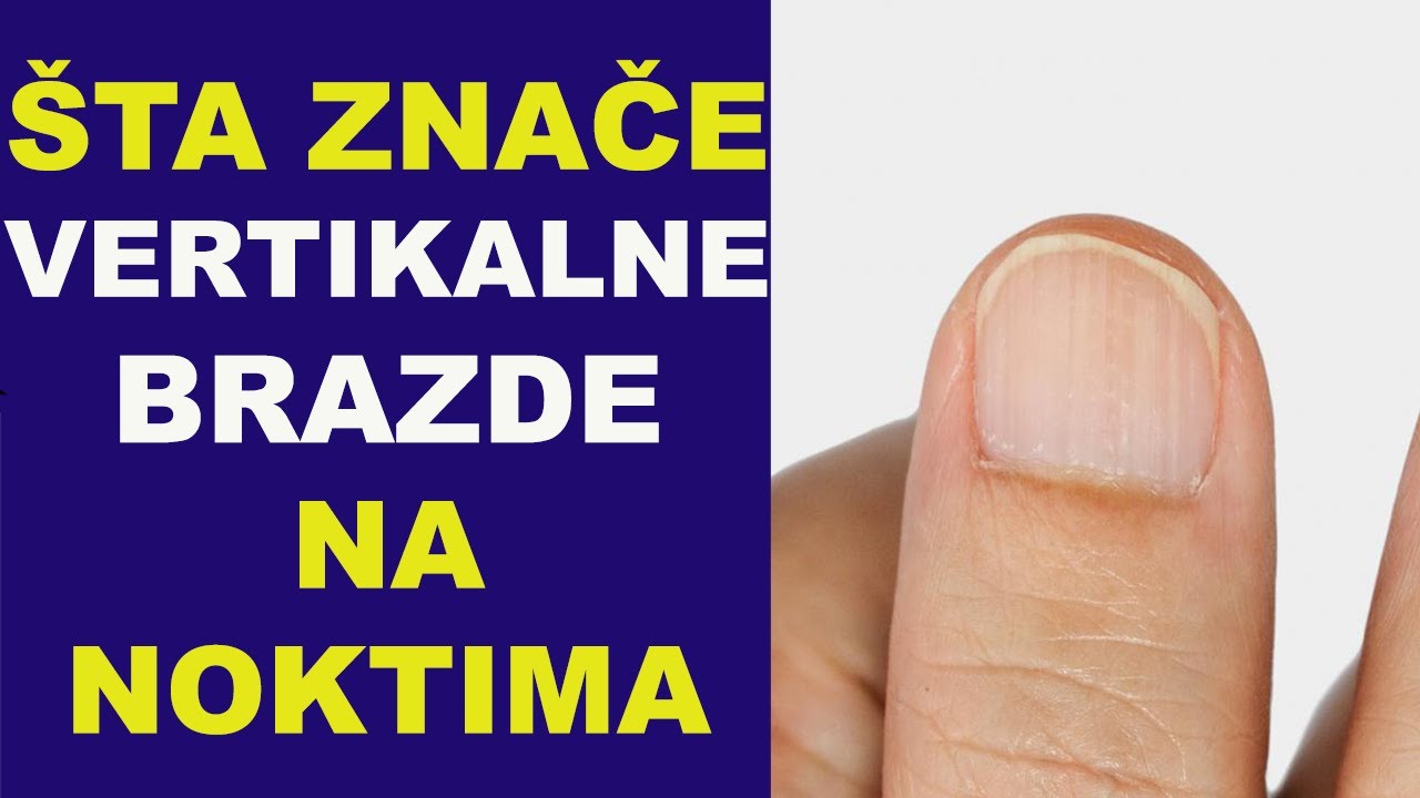 &Scaron;ta znače VERTIKALNE BRAZDE NA NOKTIMA/dr Bojana Mandić
