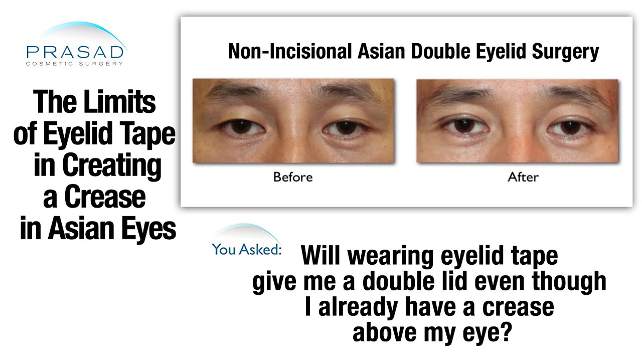 The Limits of Double Eyelid Tape in Creating an Asian Eyelid Crease