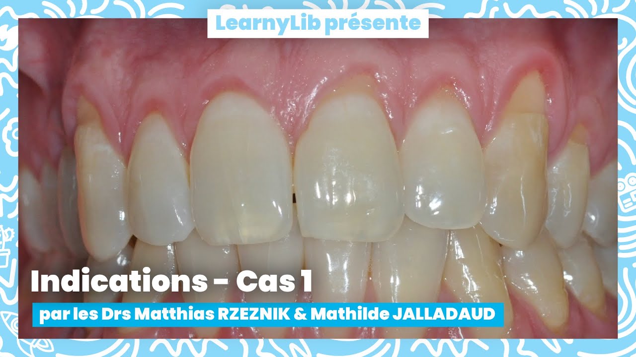 🦷 La chirurgie muco-gingivale : les indications de la greffe épithélio-conjonctive