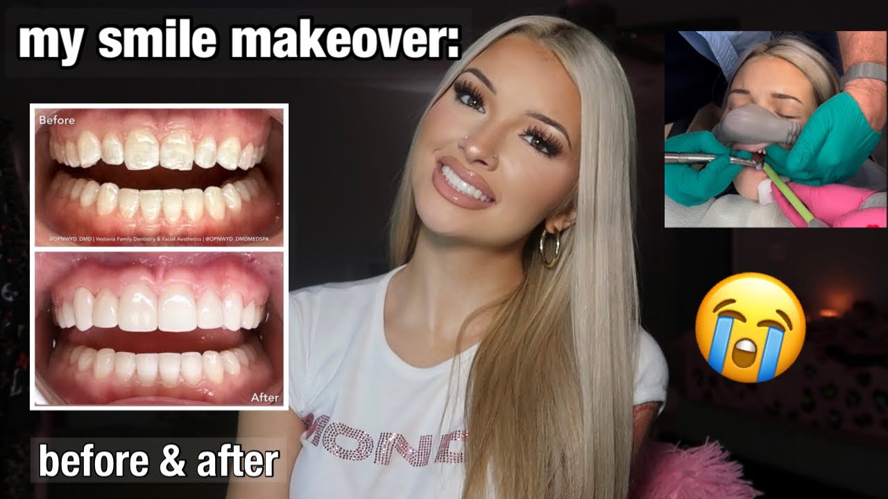 MY SMILE MAKEOVER | GETTING PORCELAIN CROWNS | $$$, pain, experience, BEFORE & AFTER, & more!