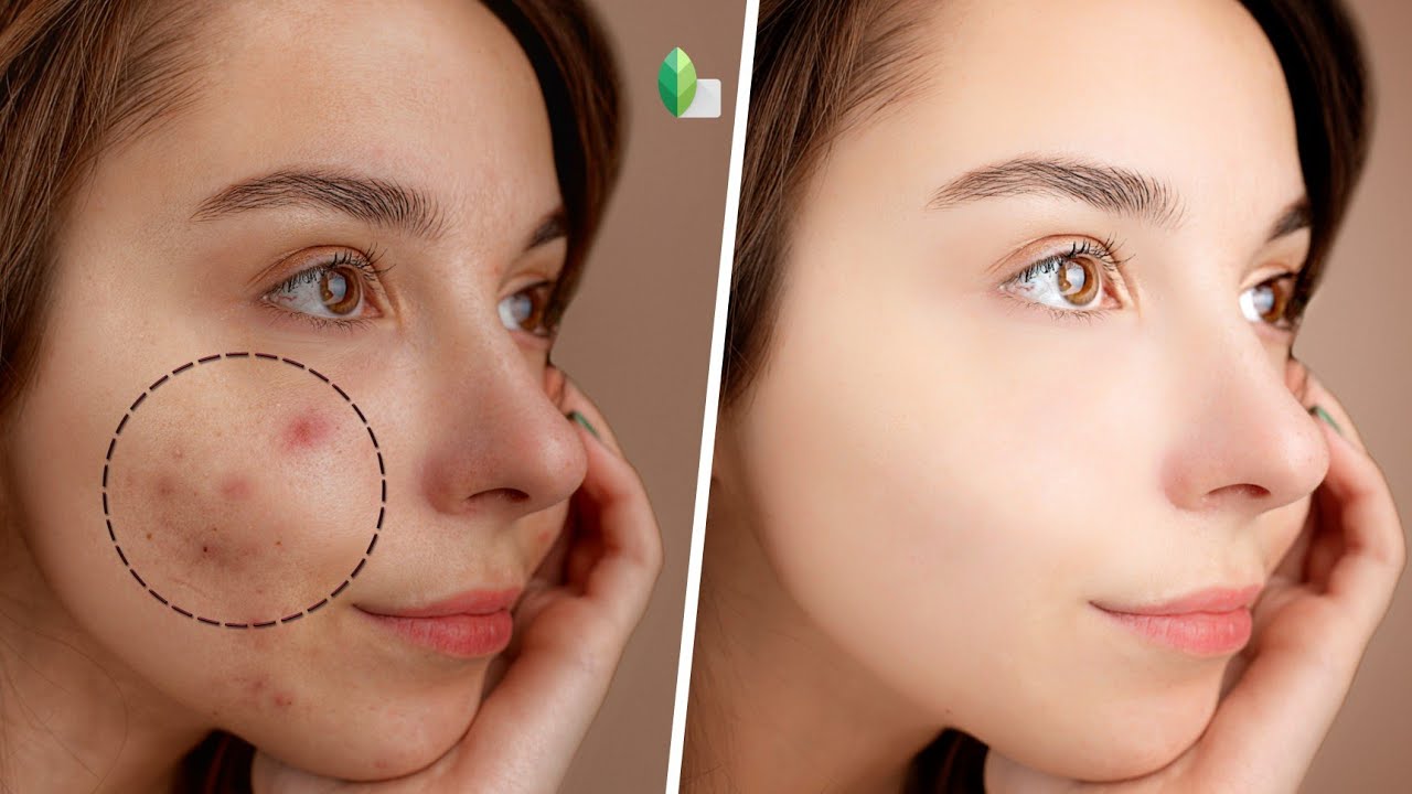 Remove Pimples And Skin Smooth Editing | Skin Glowing | Snapseed Tutorial