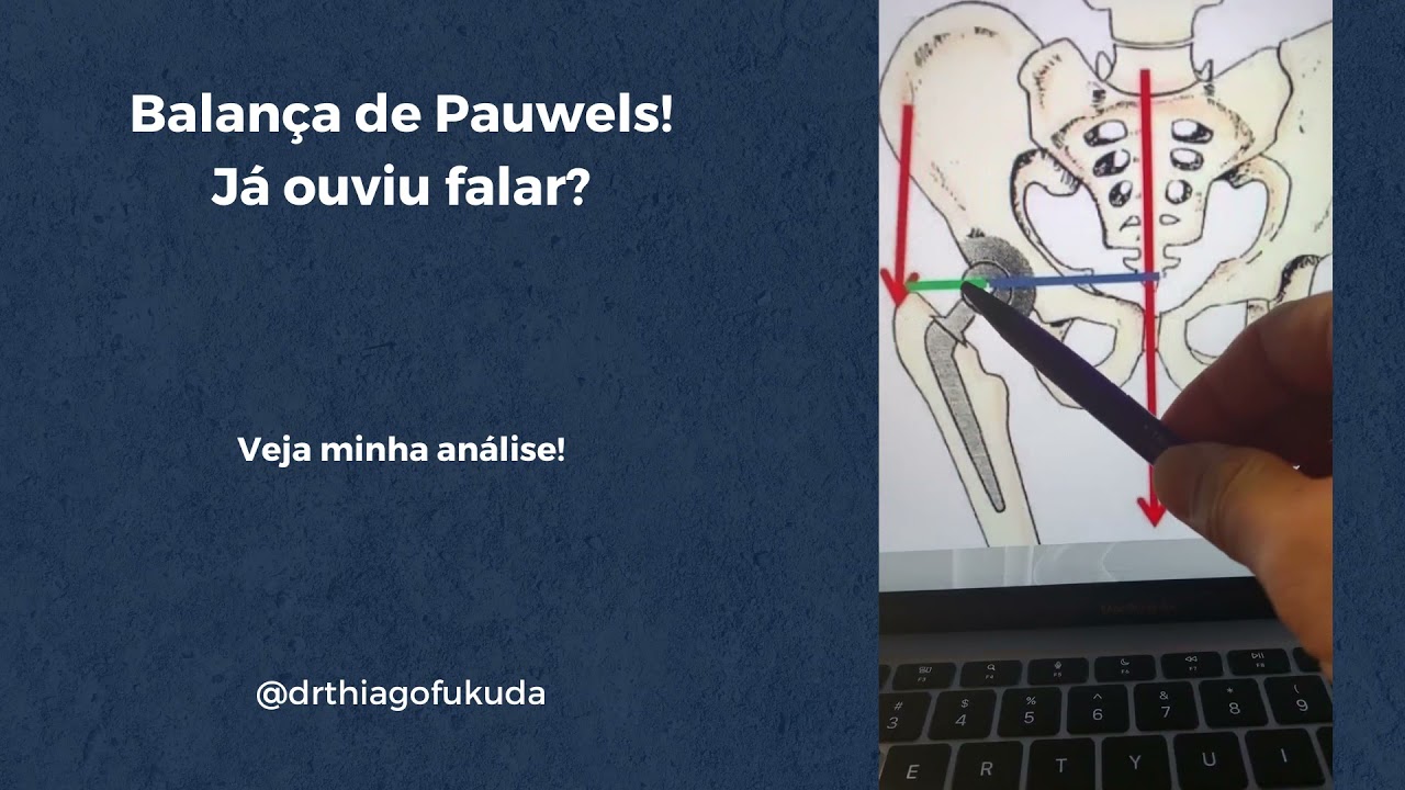Balança de Pauwels! Já ouviu falar? - Dr. Thiago Fukuda - aula completa