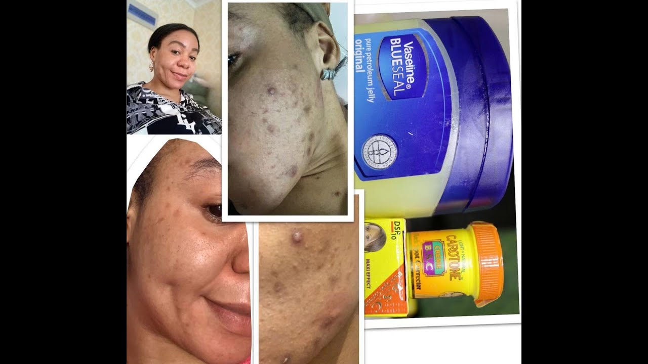 Can Carotone and Blueseal   Vaseline  treat ACNE an#let's see what it can really do#